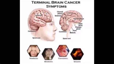 Terminal Brain Cancer Symptoms Youtube