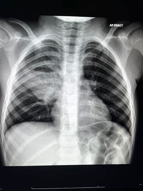 Lung Abscess Air Fluid Level On Chest X Ray Air Fluid Opacity