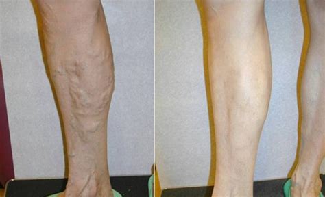 Northwest Vascular And Vein Specialists Before And After Gallery