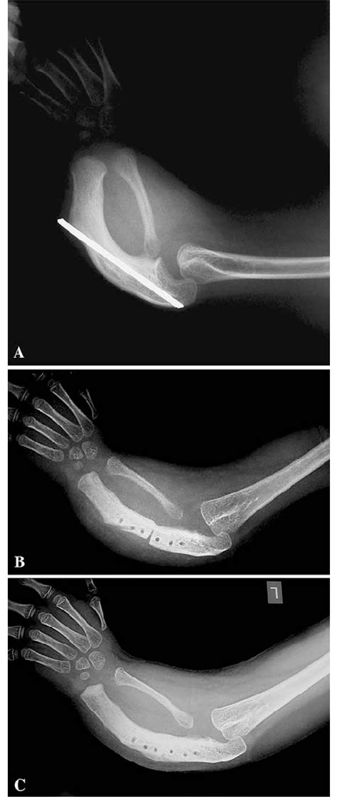 Ac The Radiographs For Patient 2 A 5 Year Old Girl With Bilateral
