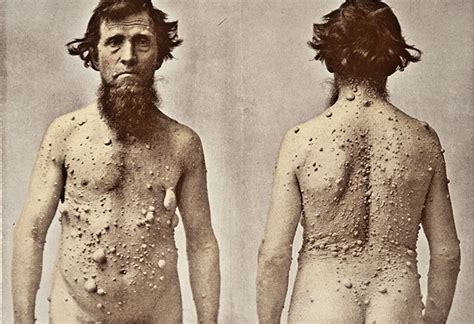 10 Of The Most Terrifying Diseases Rotting Cheeks And Eyeball