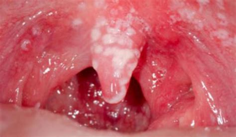 A person should see a doctor for White Patches in Mouth Pictures, Small White Spots on Roof of Mouth Leukoplakia Bumps, Cancer ...