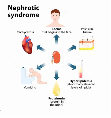 Med Nephrotic Syndrome Medicoapps Org