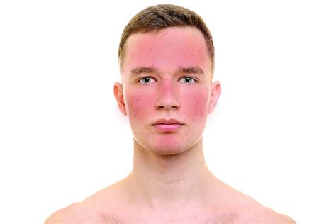 Treatments And Managing Rosacea Rochester House Clinic