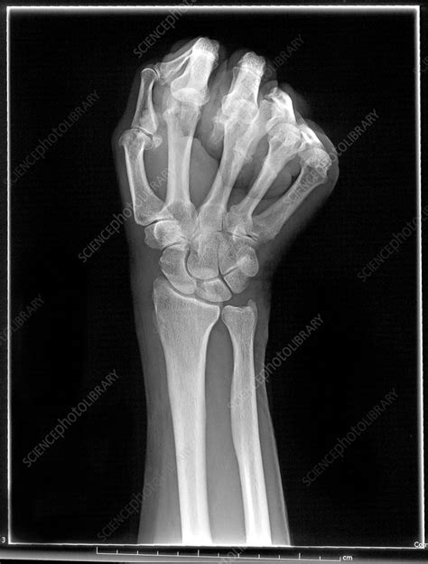 Wrist X Ray Scaphoid View Stock Image C0034813 Science