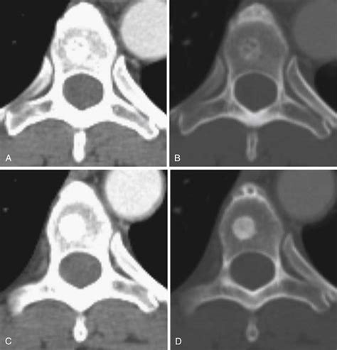 Bone Metastases Radiology Key