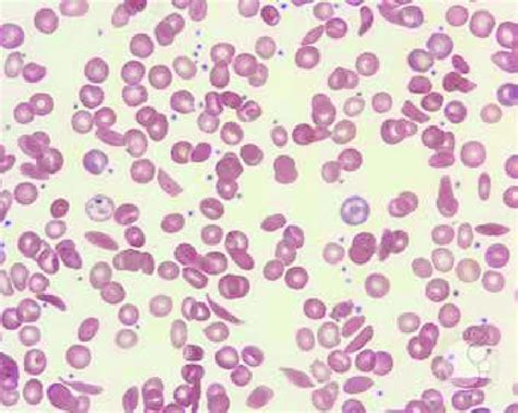 Peripheral Smear From A Patient With Sickle Cell Disease Illustrates