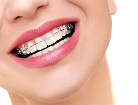 What Can Affect The Cost Of Orthodontic Treatment Central Coast