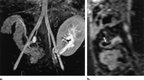 Arterial Stump Thrombosis A Contrast Enhanced Mr Angiogram Shows