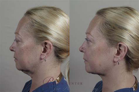 Neck Contouring Before And After Pictures Case 986 Paramus Nj