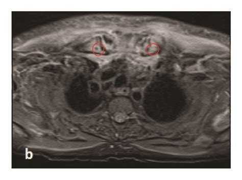 Sternoclavicular Joints Mri Scan Stir Sequence A Coronal Image B