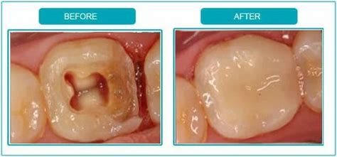 Root Canal Before After