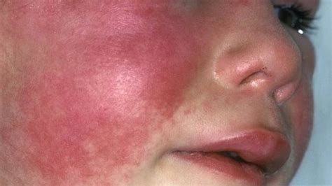 Scarlet Fever Cases Hit 50 Year High In England Bbc News