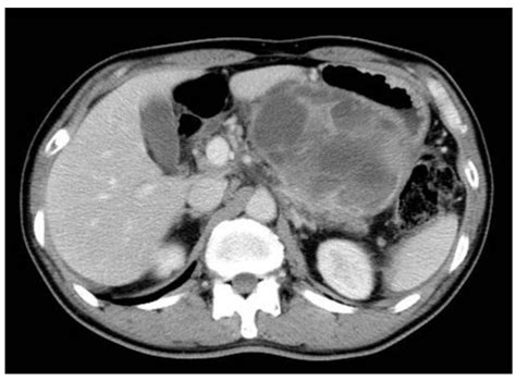 Abdominal Ct Showing The Large Cystic Tumor In The Upper Left Quadrant