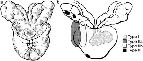 Open Radical Retropubic Prostatectomy Radiology Key