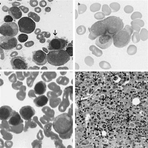 Morphological Features Of Acute Myeloid Leukemia Inv3t33 A
