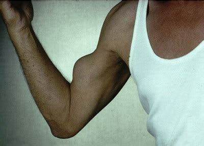 Biceps Tendo Lesions Treatment Berkshire SLAP Tear Oxfordshire Hampshire
