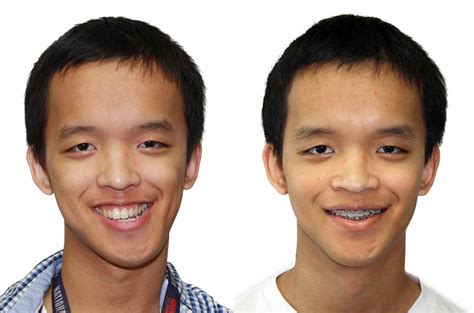 Facial Asymmetry Correction Orthognathic Surgery