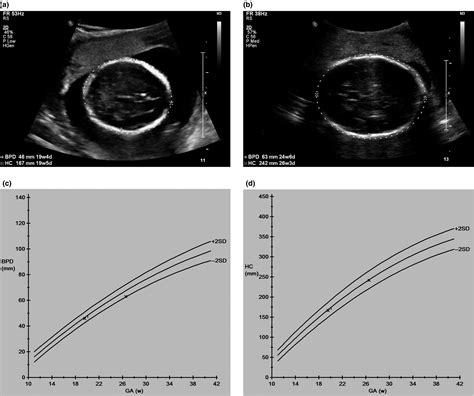 The Use Of Obstetric Ultrasound In The Antenatal Diagnosis Of