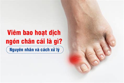 Viêm bao hoạt dịch ngón chân cái là gì Nguyên nhân và cách xử lý