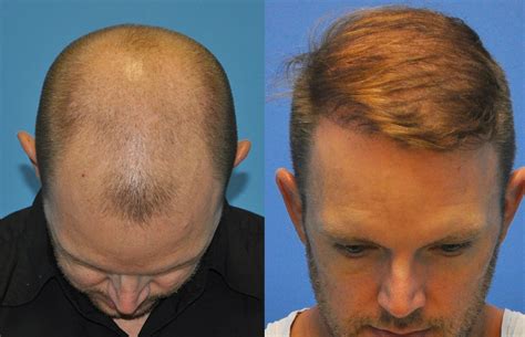 Two Day 4000 FUE Hair Grafts Case Study Carolina Hair Surgery