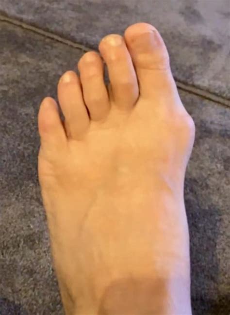 What Is The Bump On The Side Of My Foot Pro Feet Podiatry