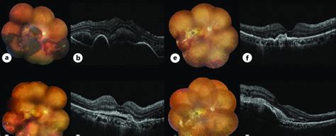 A Color Fundus Photograph Cfp Of Case 2 At Baseline Showing The