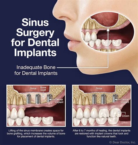 Sinus Surgery For Dental Implants J A Lewandowski Dds Leawood Kansas