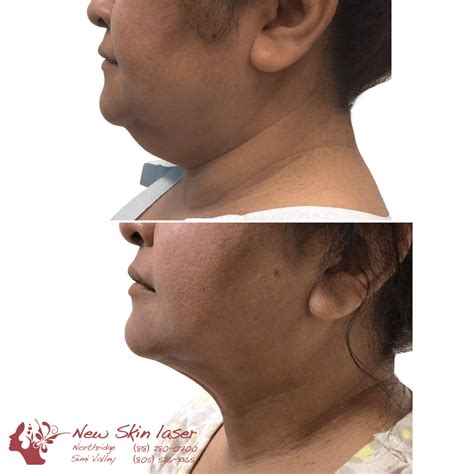 Before And After Photo Northridge And Simi Valley New Skin Laser Center