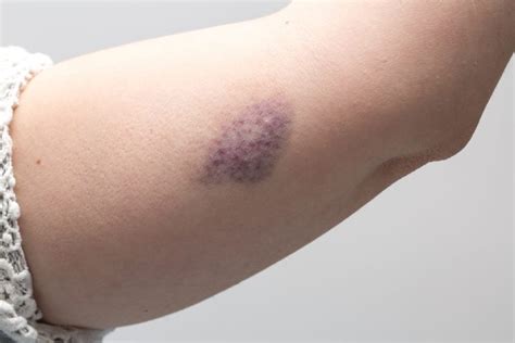 What The Color Of Your Bruise Is Trying To Tell You Readers Digest