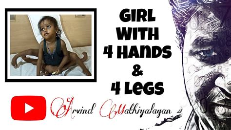 Girl With 4 Hands And 4 Legs Lakshmi Tatma Arvind Mathiyalagan