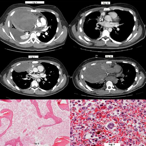 A Computed Tomography Ct Chest Scan Showing Mediastinal Mass At