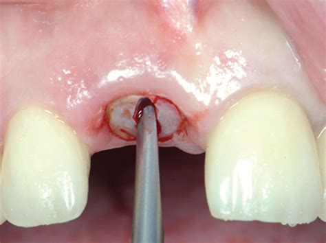 How To Extract Teeth As Atraumatically As Possible Root Sectioning