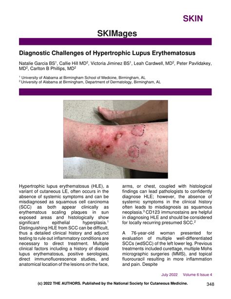 Pdf Diagnostic Challenges Of Hypertrophic Lupus Erythematosus