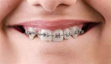 為什麼戴牙套後牙齒會反彈？ 每日頭條
