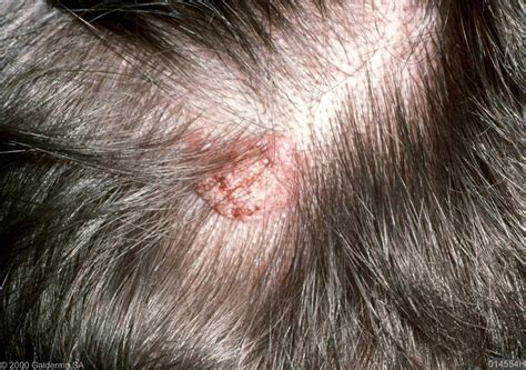 Scalp Growths Pictures Photos
