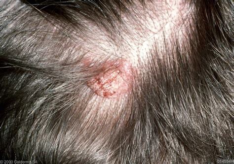 Red Itchy Bumps On Scalp