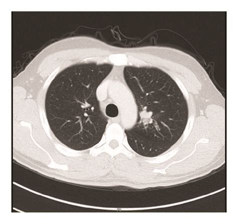 The Computed Tomography Ct Scan Showed A Lobulated Round Nodule In