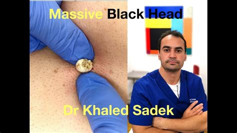 Massive Blackhead Extraction Dr Khaled Sadek LipomaCyst Com YouTube