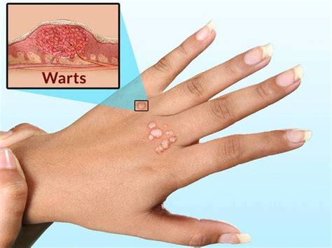 Removing Warts Warts Warts On Hands Wart On Finger