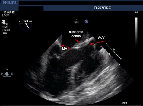 Part 1 Tee Evaluation Of The Mitral Valve Congenital Cardiac