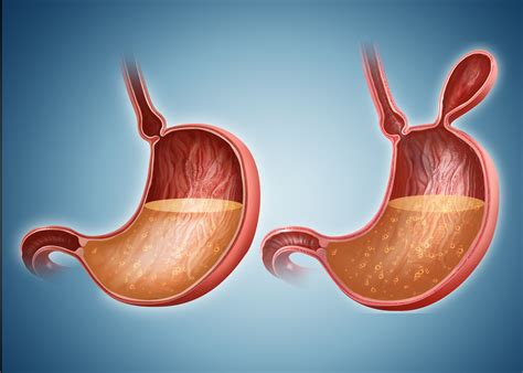 Bowel Obstruction Symptoms Causes Diagnosis And Treatment