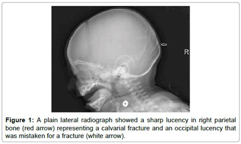 Clinical Case Reports Plain Lateral Radiograph