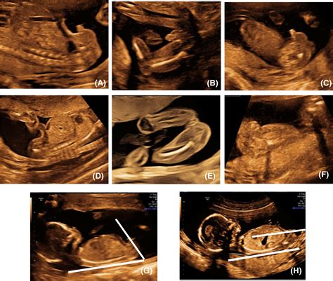 Fetal Sex Determination During Ultrasonography Should We Focus On How