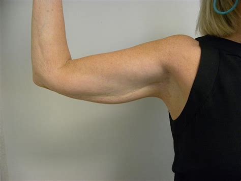 Arm Lift Before And After Pictures Miami Aventura Fl