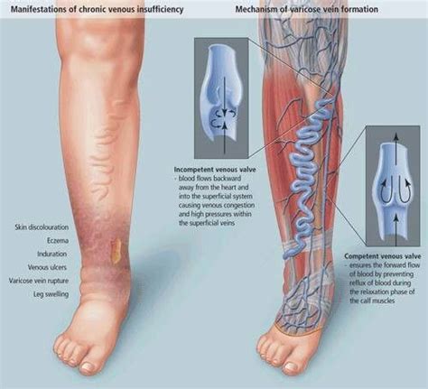 Varicose Vein Tx Medical Surgical Nursing Surgical