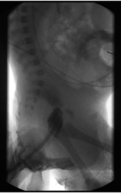 Magnamosis A Novel Technique For The Management Of Rectal Atresia