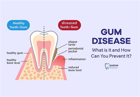 Gum Disease What Is It And How Can You Prevent It Hanson Dental