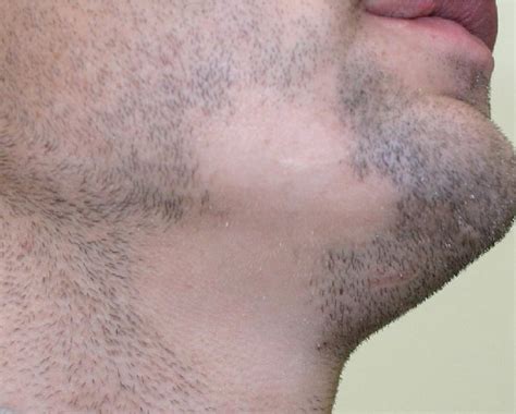 Update 75 Beard Hair Loss Fungus Best Ineteachers