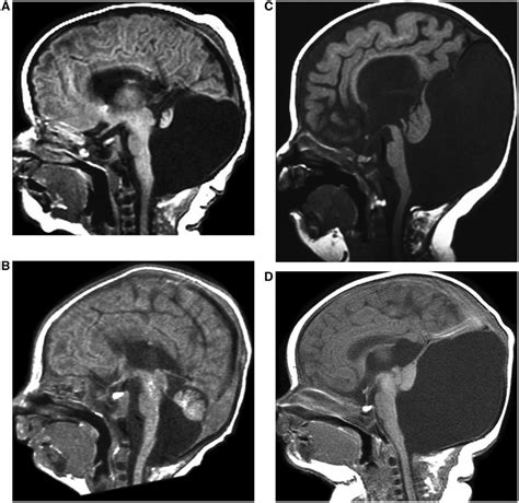 Dandy Walker Malformations With Multiple Associated Geneticclinical